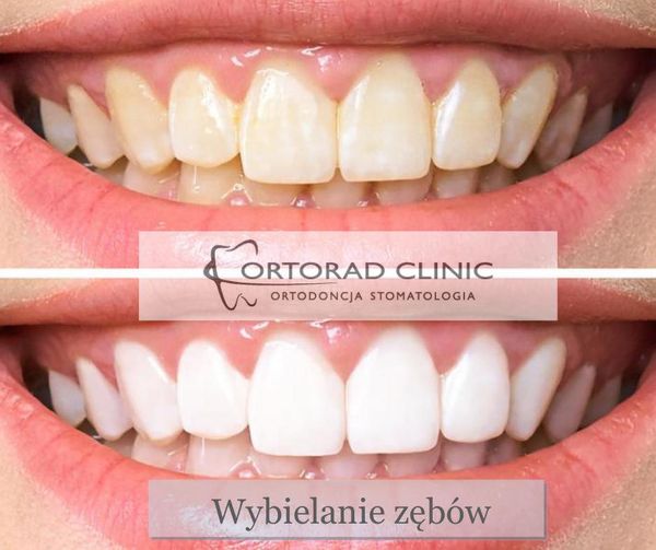 Wybielanie zębów