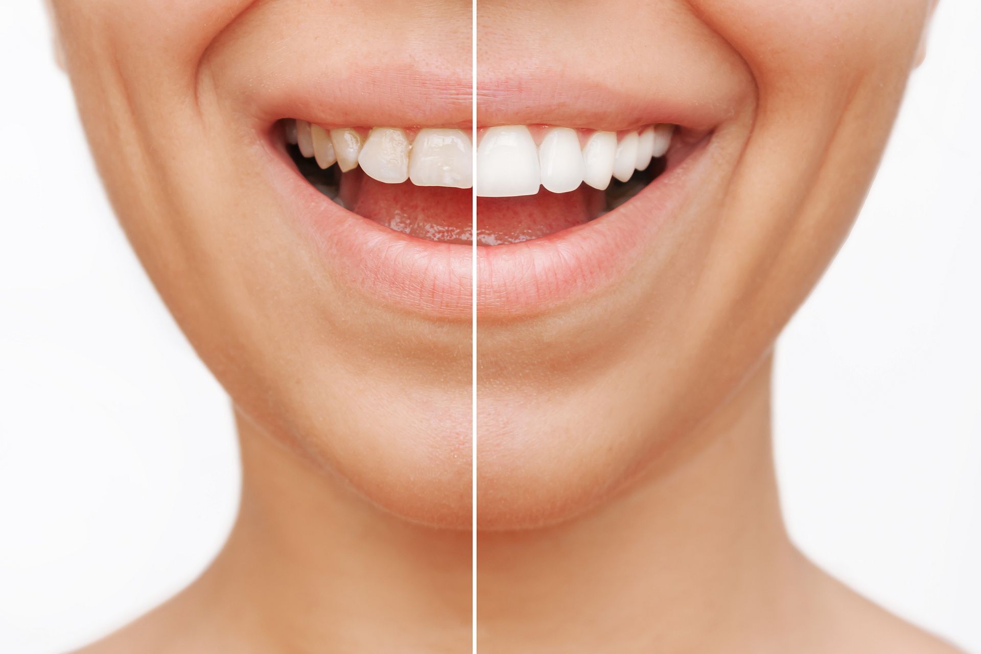 Licówki dla pacjentów po ortodoncji - czy warto?